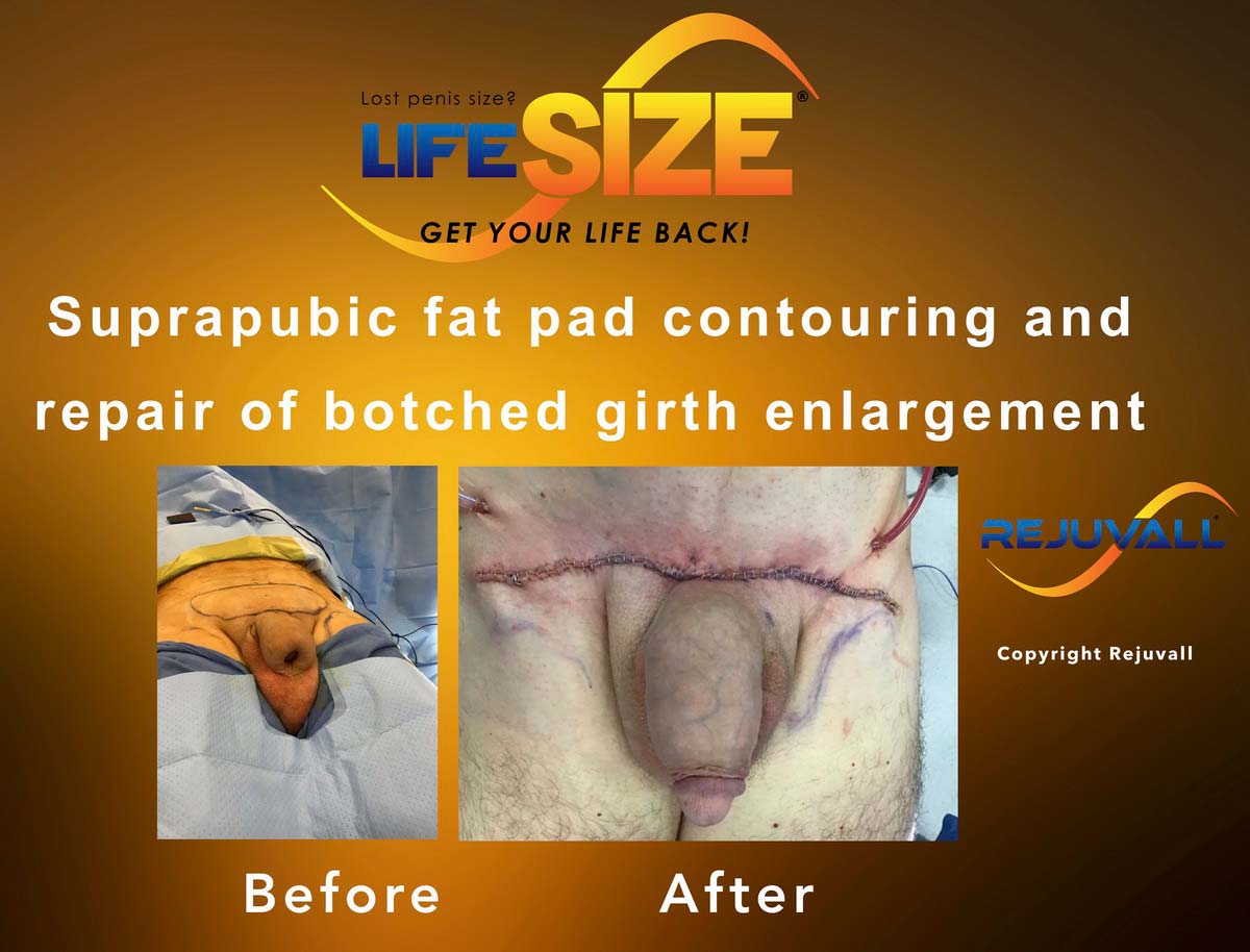 before after botched penis surgery