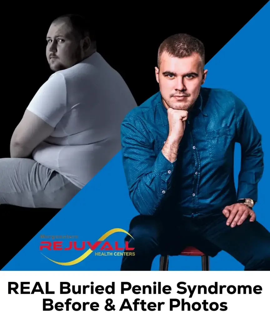 buried penile syndrome real photos gallery image