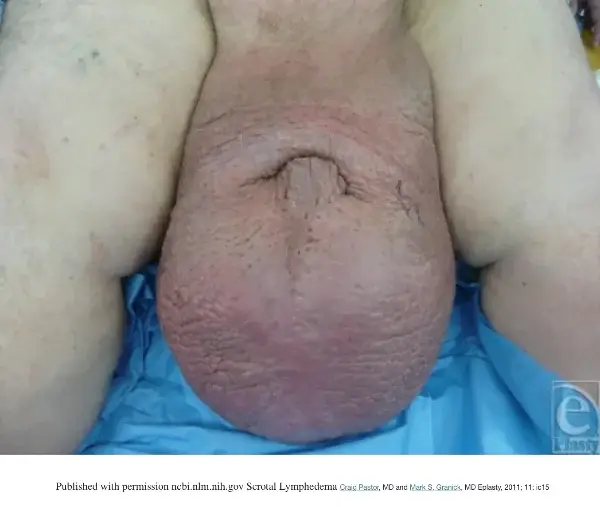 enlarged penis lymphedema Dickens pic