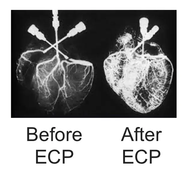 ECP increases penile blood flow before after