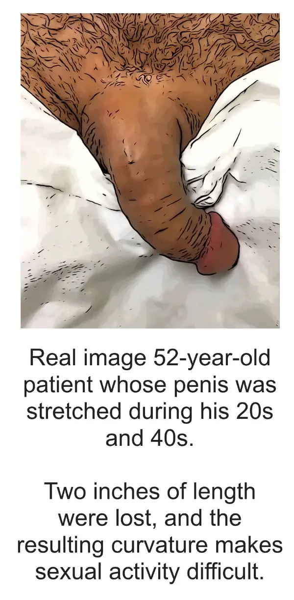 Bent penis before stretching procedure