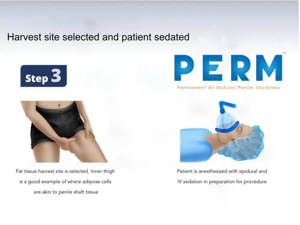 procedure increase penile girth