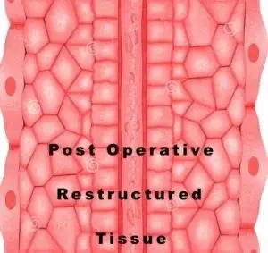 after surgical tissue fat transfer pic