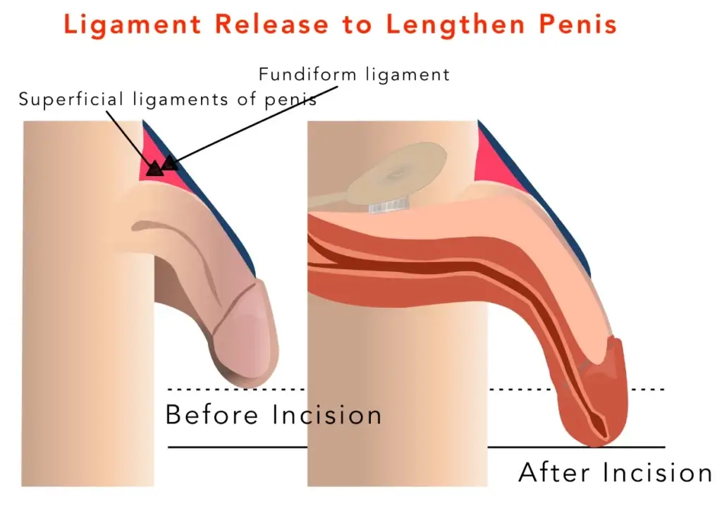 Penis Enlargement Surgery FAQ