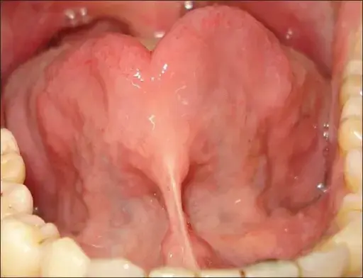 closeup of the frenulum under someone's tongue