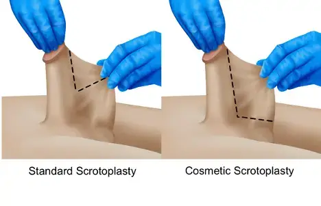 medical illustrations with cut lines of a standard scrotoplasty vs a cosmetic scrotoplasty