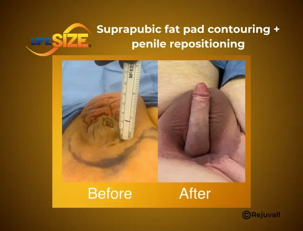 Before and after results of penis enlargement surgery with suprapubic fat pad contouring and penile repositioning. The left image shows a buried penis with a prominent fat pad, while the right image displays a significantly enhanced and lengthened penis post-surgery.