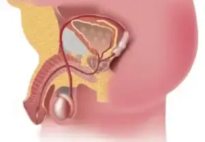 Medical illustration showing how excess weight affects penis size by causing fat accumulation around the pubic area, making the penis appear smaller.