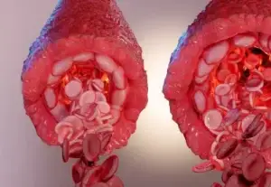 3D medical illustration of blood vessels, showing restricted and healthy blood flow. Poor circulation can cause the penis to become smaller due to blood flow issues affecting erectile function and tissue health.