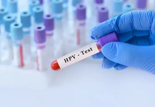 Medical professional holding an HPV test vial, highlighting the connection between circumcision and STDs. Studies suggest that adult circumcision may reduce the risk of sexually transmitted infections like HPV and HIV.