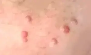 Close-up image of pearly penile papules (PPP) showing small, skin-colored bumps on the penile shaft. These harmless, non-contagious papules are often mistaken for genital warts.