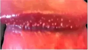 Detailed image of pearly penile papules (PPP) appearing as small white or flesh-colored bumps around the corona of the glans penis. These benign papules are a common anatomical variation and are not caused by an STD.