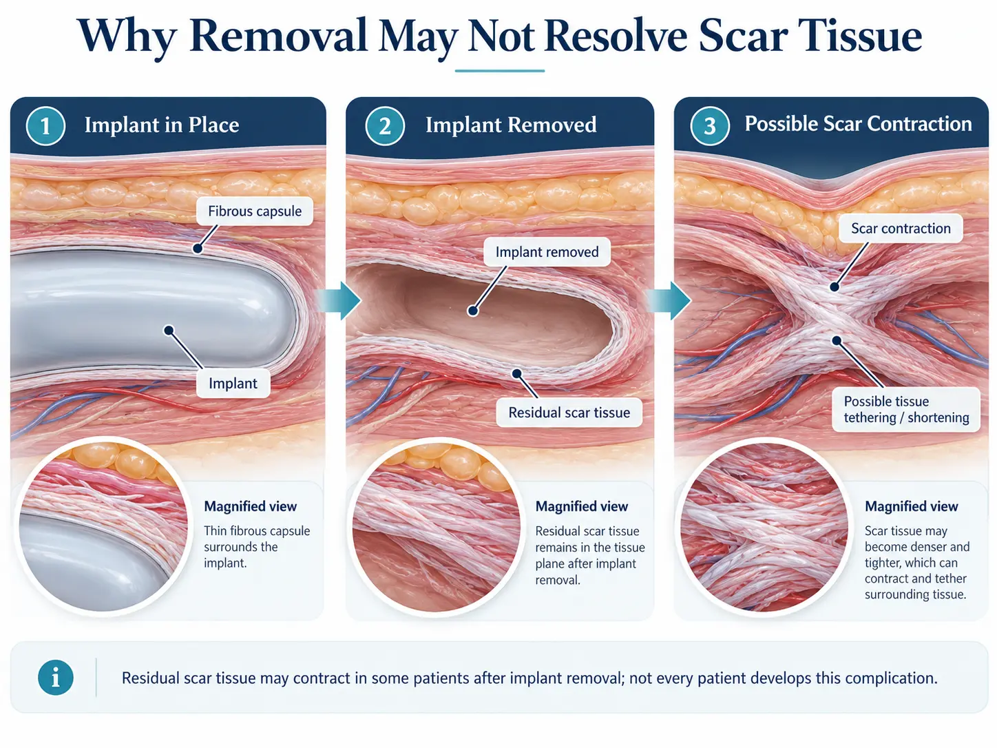 Three-stage illustration showing implant placement, residual scar tissue after removal, and possible tissue contraction