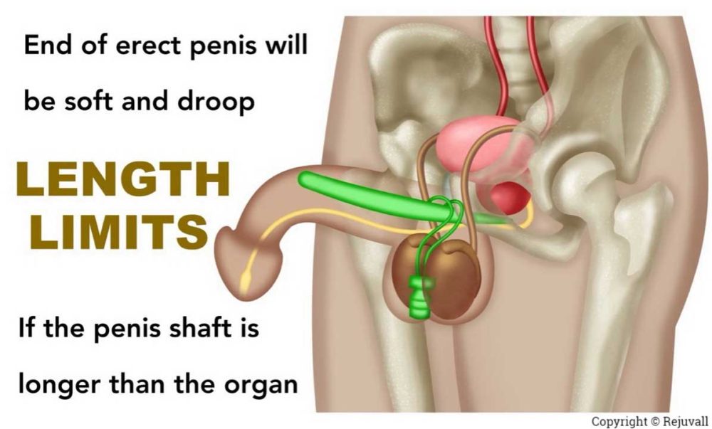 Limits-of-Surgical-Penile-Lengthening