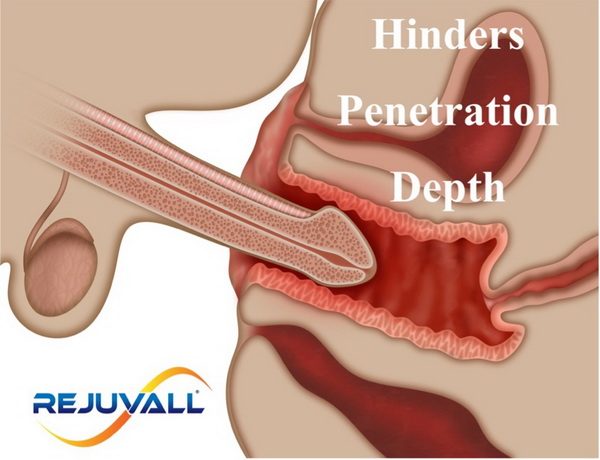 penetration diagram shortened penis