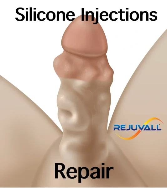 silicone girth injections repair